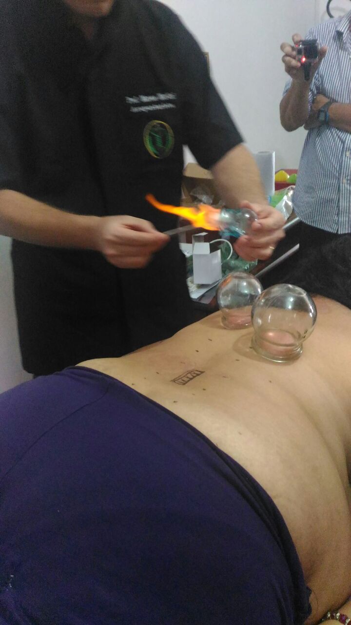 Demonstração prática da aplicação de ventosas de fogo
